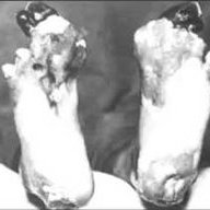 Trenchfoot